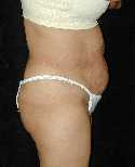 Tummy Tuck Surgery