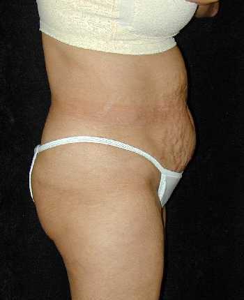 Tummy Tuck Surgery