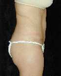 Tummy Tuck Surgery