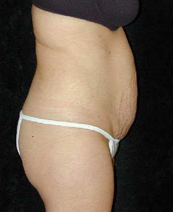 Tummy Tuck Surgery