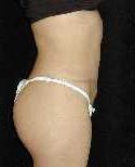 Tummy Tuck Surgery