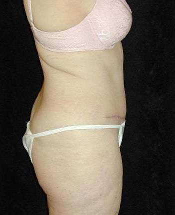 Tummy Tuck Surgery