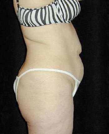 Tummy Tuck Surgery