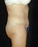 Tummy Tuck Surgery