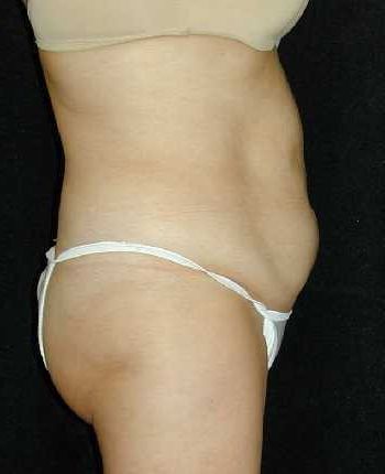 Tummy Tuck Surgery