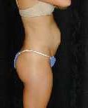 Tummy Tuck Surgery