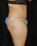 Tummy Tuck Surgery