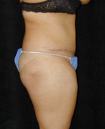 Tummy Tuck Surgery