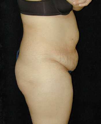 Tummy Tuck Surgery