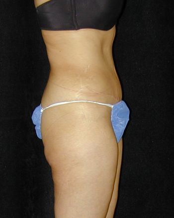 Tummy Tuck Surgery