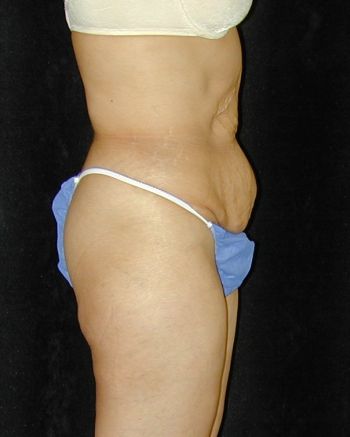 Tummy Tuck Surgery