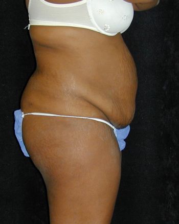 Tummy Tuck Surgery