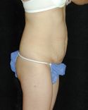 Tummy Tuck Surgery