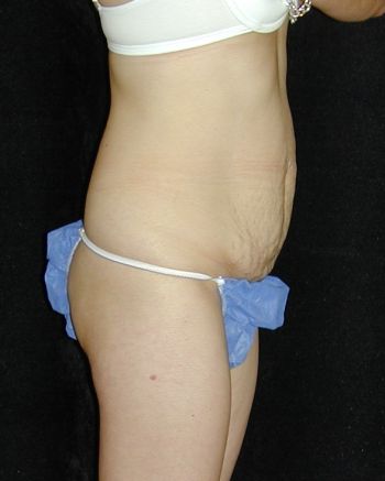 Tummy Tuck Surgery