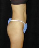 Tummy Tuck Surgery