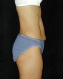 Tummy Tuck Surgery