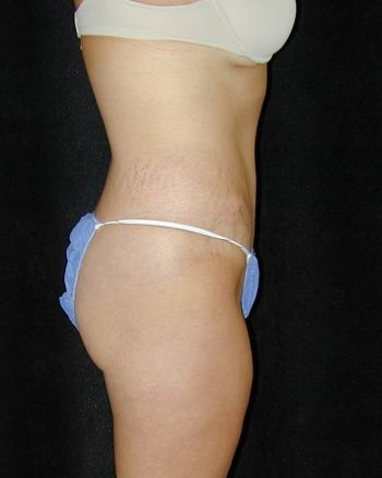 Tummy Tuck Surgery