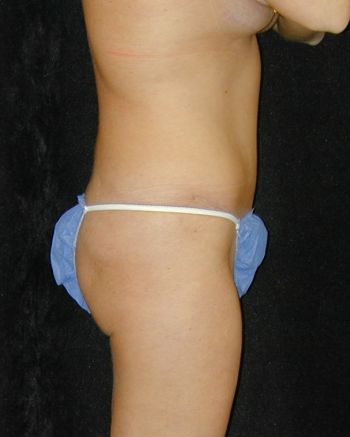 Tummy Tuck Surgery