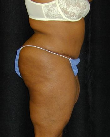 Tummy Tuck Surgery