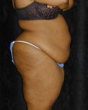 Tummy Tuck Surgery