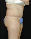 Tummy Tuck Surgery