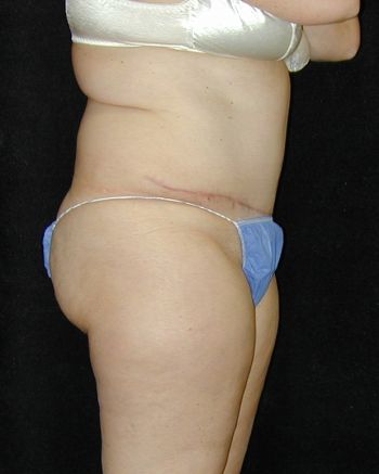 Tummy Tuck Surgery