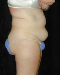 Tummy Tuck Surgery