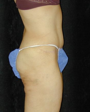 Tummy Tuck Surgery