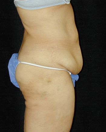 Tummy Tuck Surgery