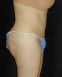 Tummy Tuck Surgery