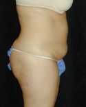 Tummy Tuck Surgery