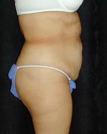 Tummy Tuck Surgery