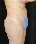 Tummy Tuck Surgery