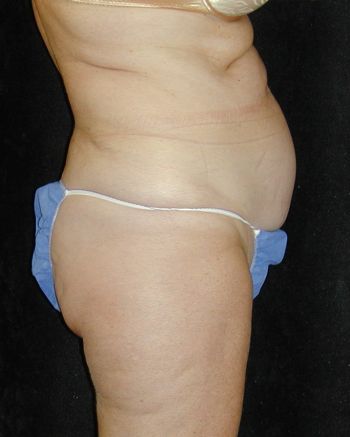 Tummy Tuck Surgery