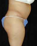 Tummy Tuck Surgery