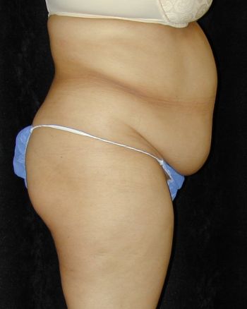 Tummy Tuck Surgery