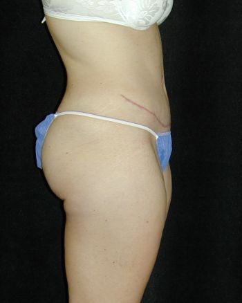 Tummy Tuck Surgery