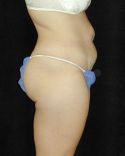 Tummy Tuck Surgery