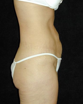 Tummy Tuck Surgery